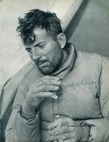 
But Victory Is Ours - Maurice Herzog Showing His Frost Bitten Hands
